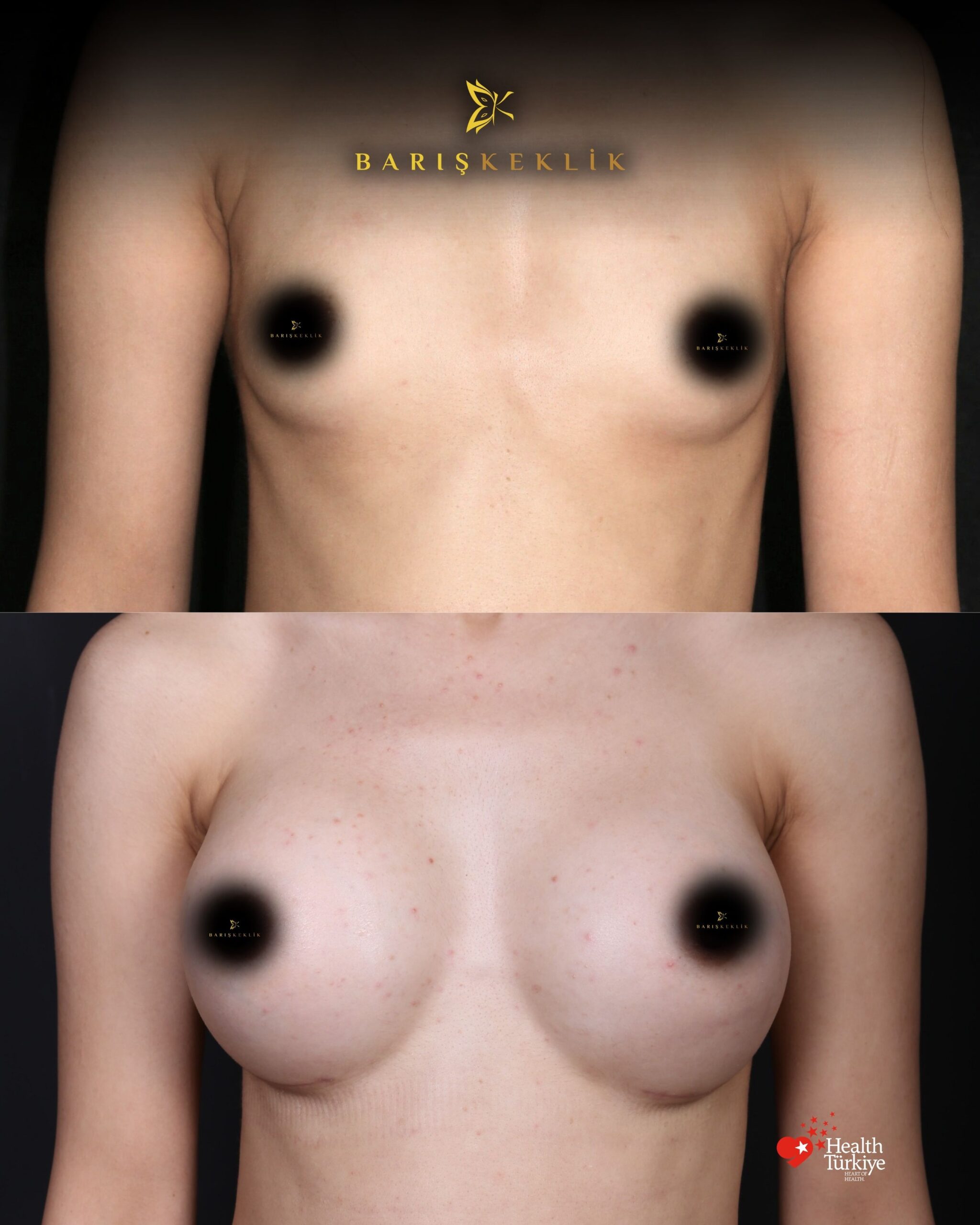 Breast Aesthetics in Turkey 25 2 scaled