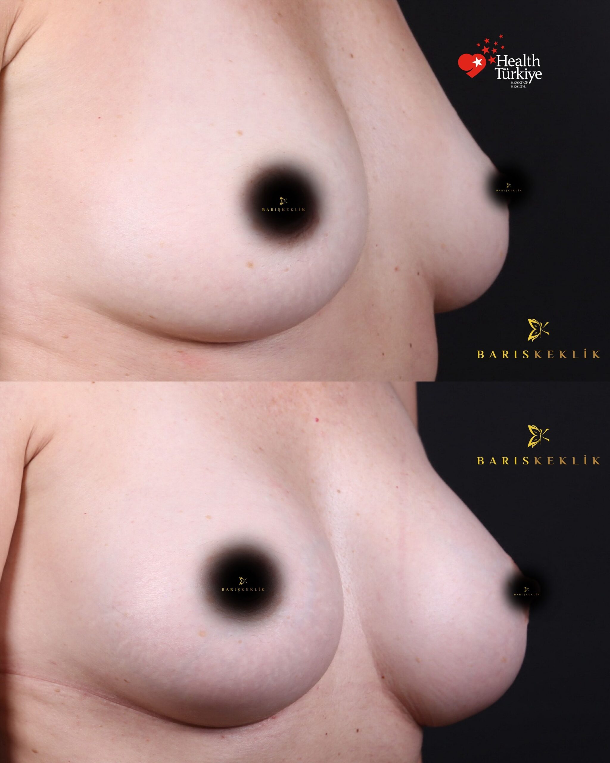Breast Aesthetics in Turkey 24 26 scaled