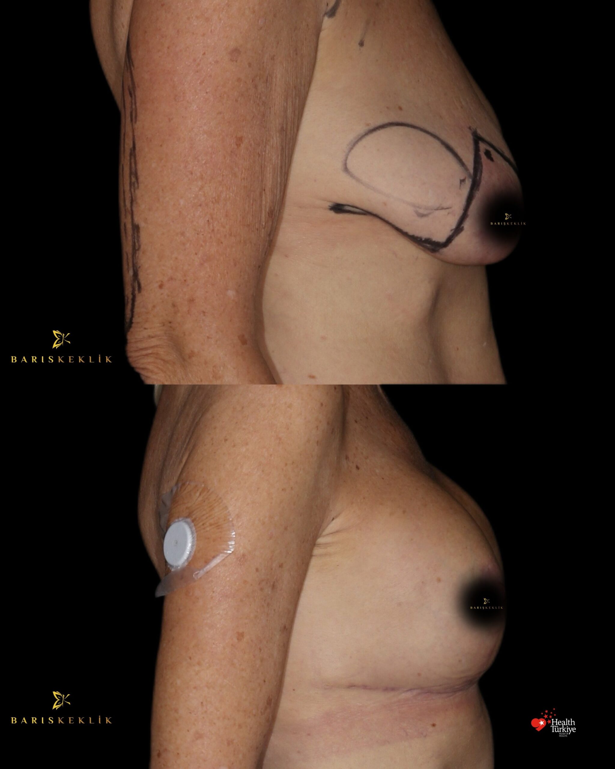Breast Aesthetics in Turkey 23 51 scaled