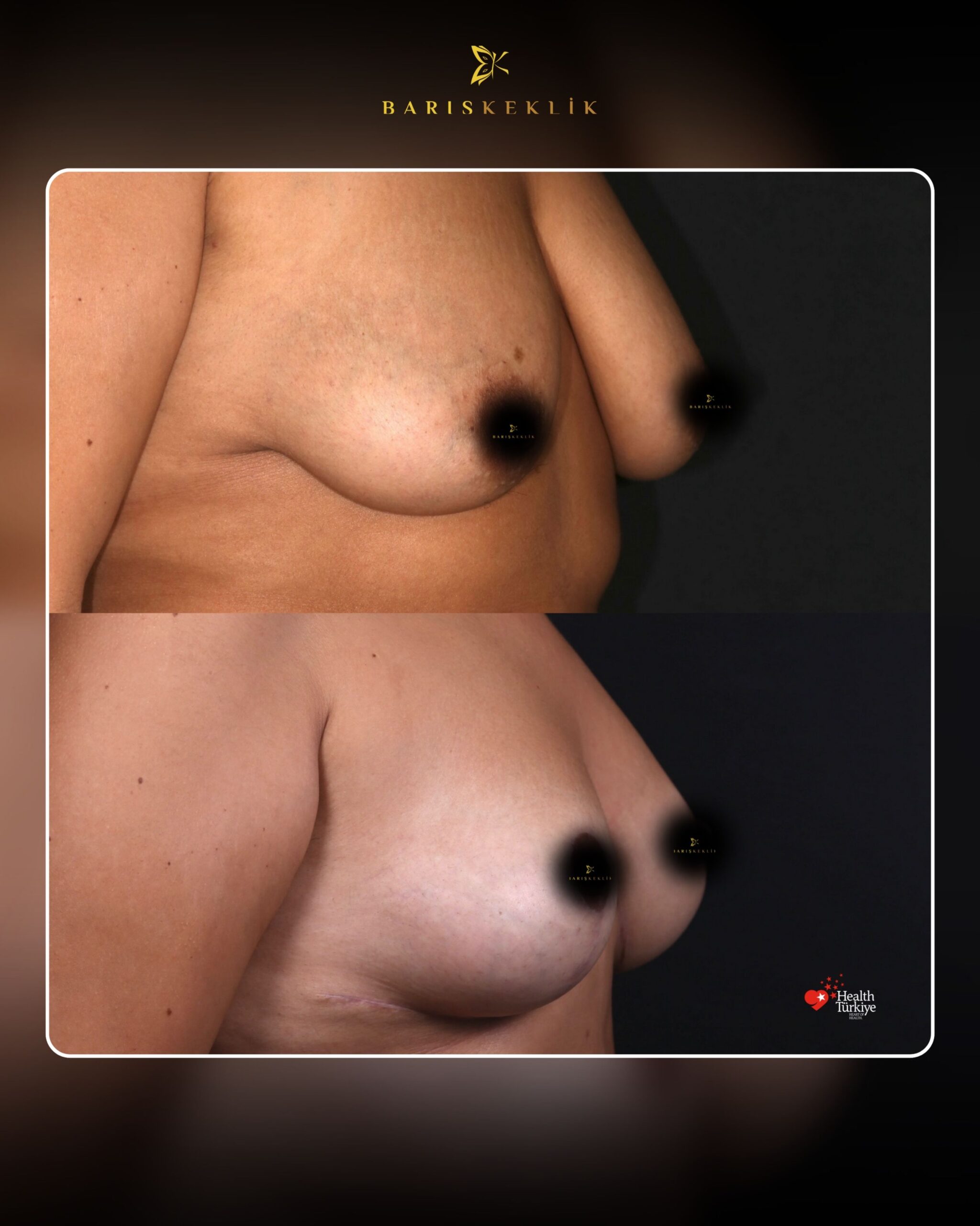 Breast Aesthetics in Turkey 21 97 scaled